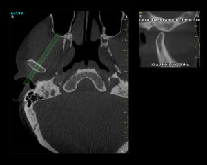 Πάχος Πανοραμικής Τομής | oralradiology.gr