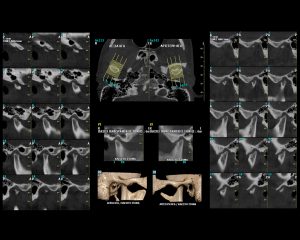 Πάχος Πανοραμικής Τομής | oralradiology.gr