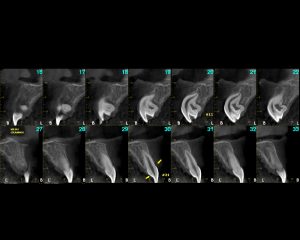 Εγκολεασμός Αδαμαντίνης | oralradiology.gr