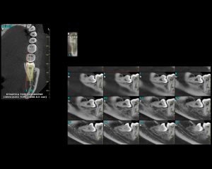 Εγκάρσια Τομή Αναφοράς | oralradiology.gr