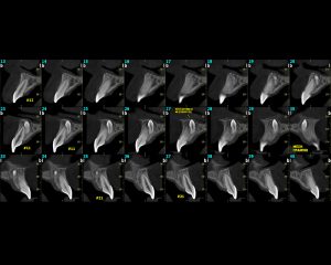 Υπεραριθμός Μεσοδοντίας | oralradiology.gr