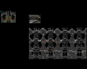 Πάχος Πανοραμικής Τομής | oralradiology.gr