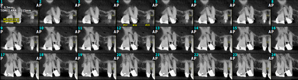 Ενασβεστίωση Ριζικού Σωλήνα | oralradiology.gr