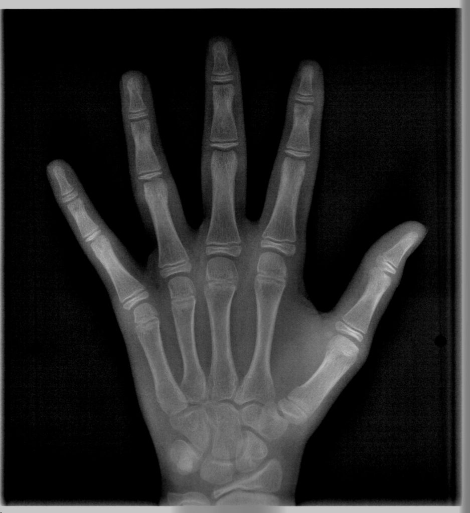 Άκρας Χειρός Οδοντιατρική Ακτινοδιάγνωση Χαλκίδα