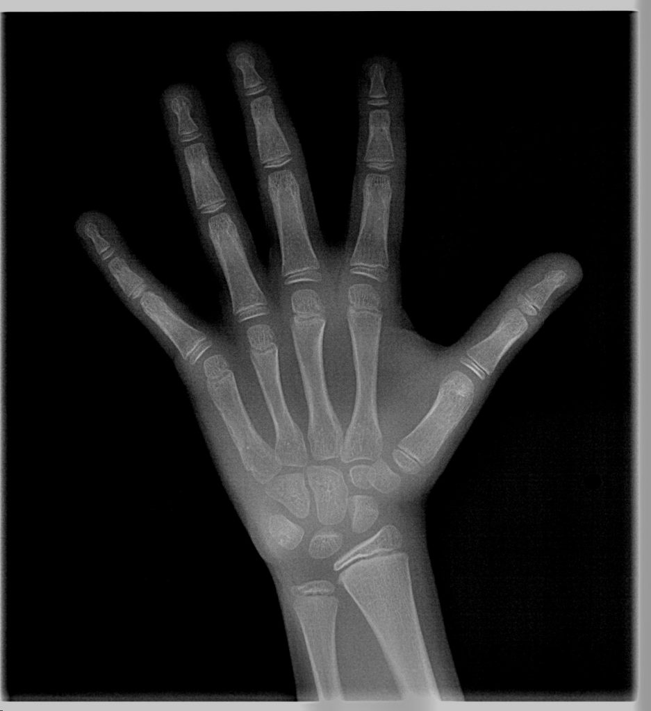 Άκρας Χειρός Οδοντιατρική Ακτινοδιάγνωση Χαλκίδα