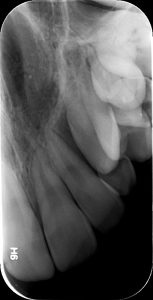 Δήξεως Οδοντιατρική Ακτινοδιάγνωση Χαλκίδα