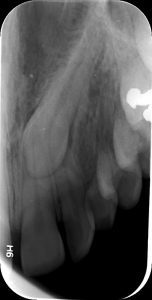 Δήξεως Οδοντιατρική Ακτινοδιάγνωση Χαλκίδα