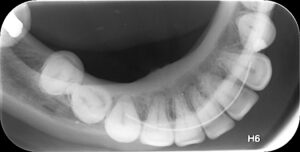 Δήξεως Οδοντιατρική Ακτινοδιάγνωση Χαλκίδα