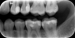 Οπισθομυλική Οδοντιατρική Ακτινοδιάγνωση Χαλκίδα