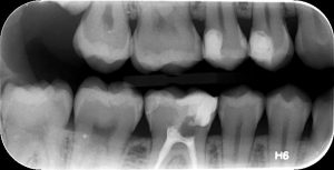 Οπισθομυλική Οδοντιατρική Ακτινοδιάγνωση Χαλκίδα