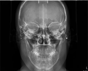 Οπισθοπρόσθια Κεφαλομετρική Οδοντιατρική Ακτινοδιάγνωση Χαλκίδα