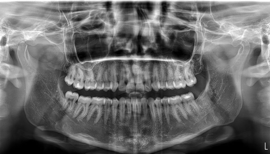 Πανοραμική Οδοντιατρική Ακτινοδιάγνωση Χαλκίδα