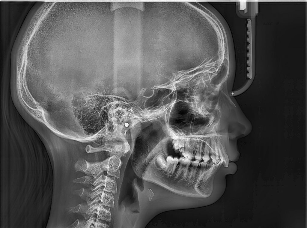 Πλάγια Κεφαλομετρική Οδοντιατρική Ακτινοδιάγνωση Χαλκίδα